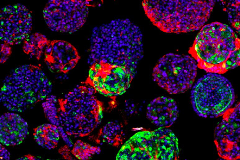 Organoidi del fegato coltivati in laboratorio aiutano a studiare i tumori del fegato. In verde le cellule staminali tumorali (fonte: Benedetta Artegiani / Princess Máxima Center for pediatric oncology) - RIPRODUZIONE RISERVATA